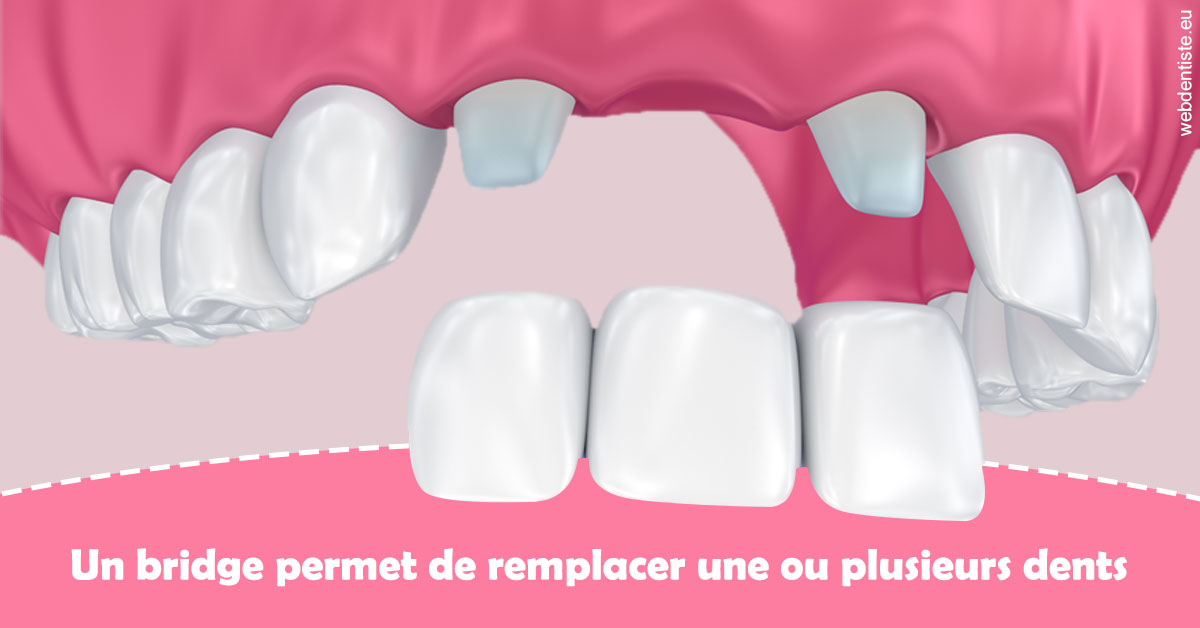 https://dr-strauss-jp.chirurgiens-dentistes.fr/Bridge remplacer dents 2