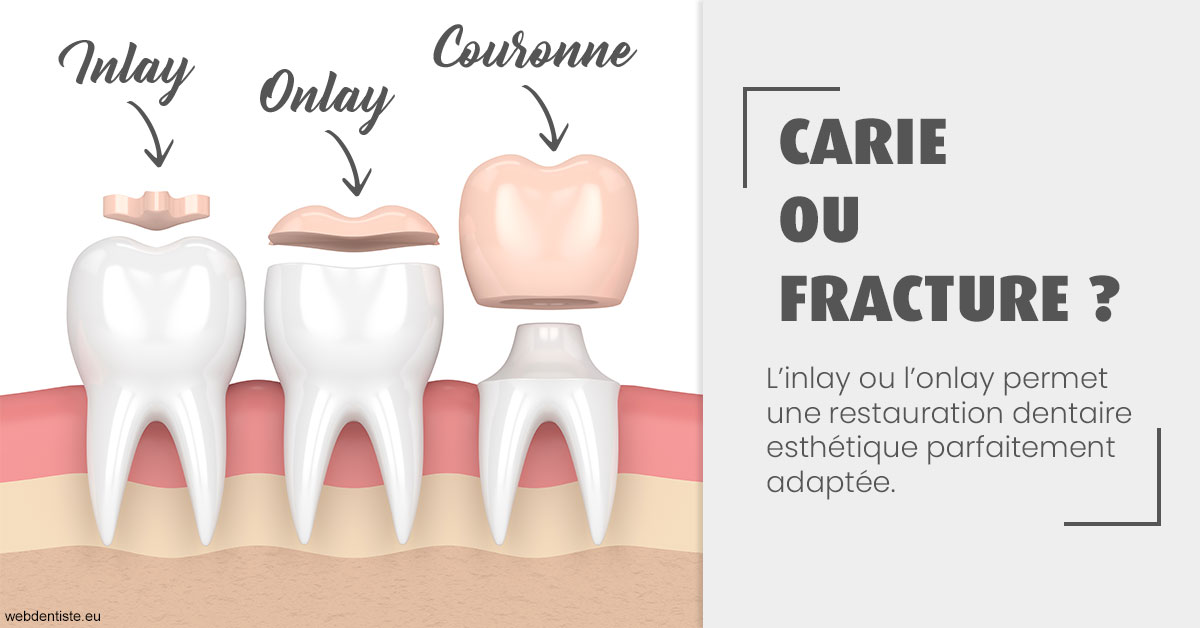 https://dr-strauss-jp.chirurgiens-dentistes.fr/T2 2023 - Carie ou fracture 1