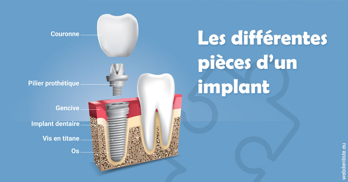 https://dr-strauss-jp.chirurgiens-dentistes.fr/Les différentes pièces d’un implant 1